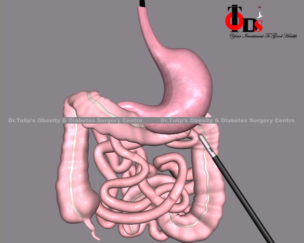 Ileal Interposition Surgery